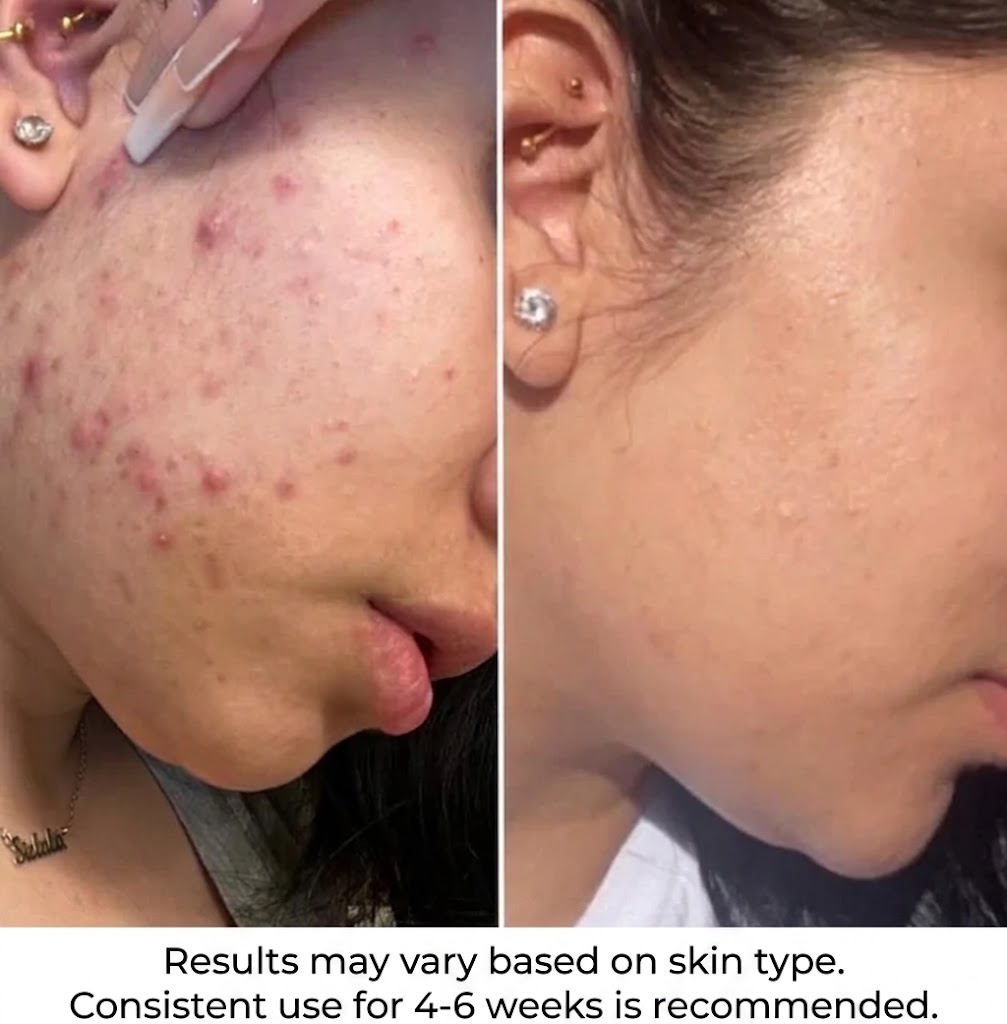 Acne Serum